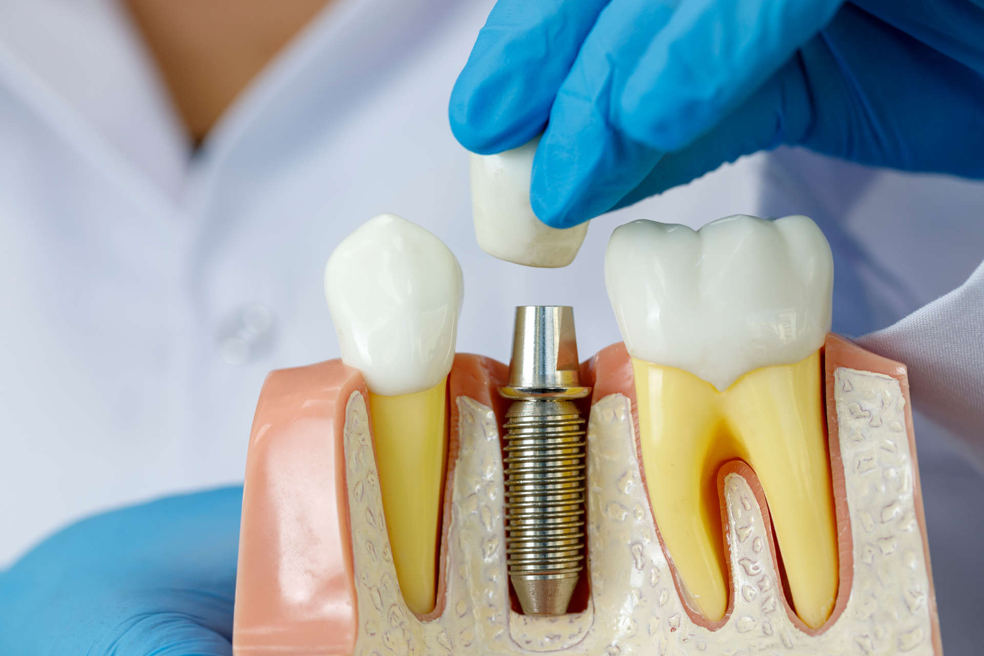 Are You Eligible For Dental Implants?