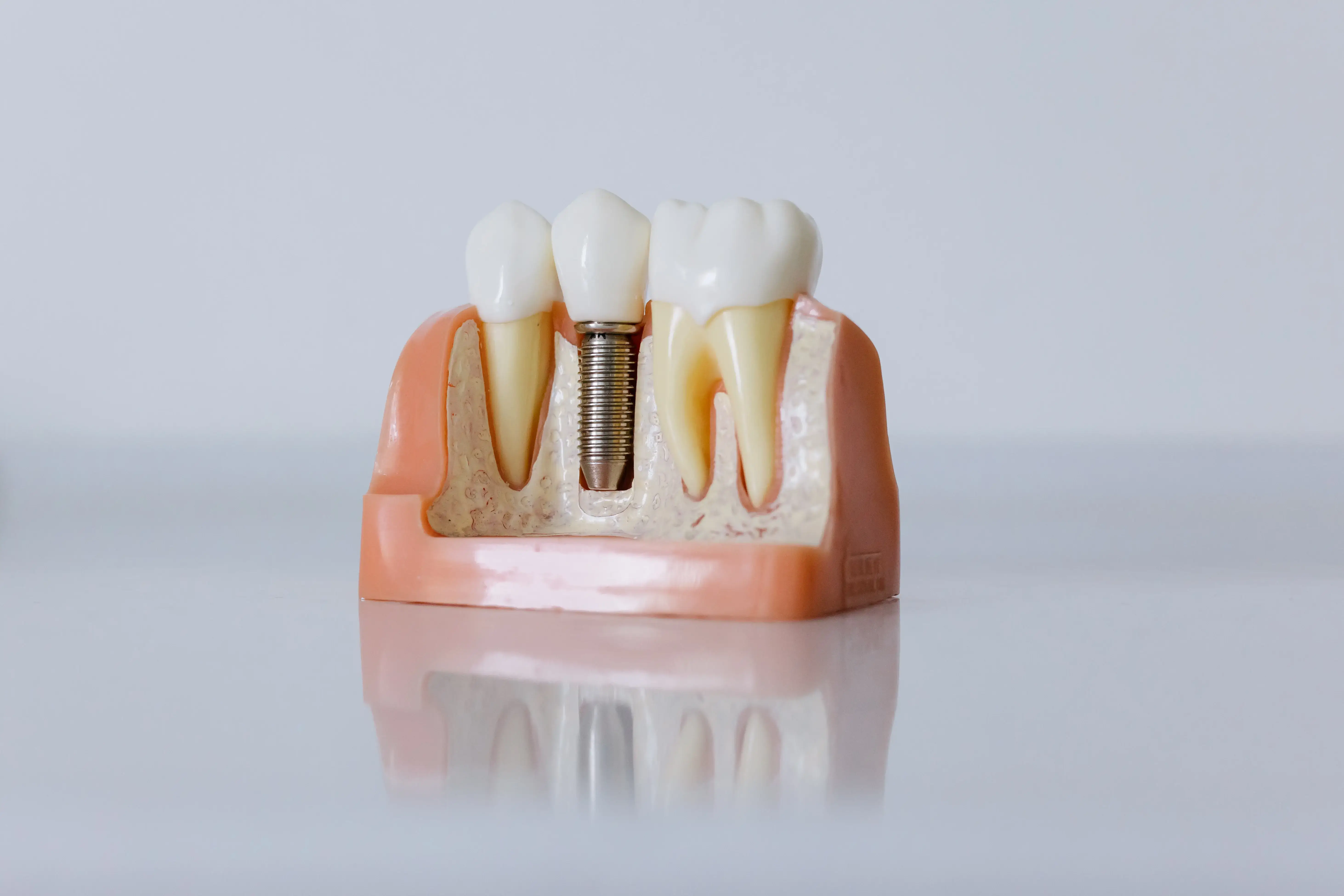 What is a full-mouth dental implant