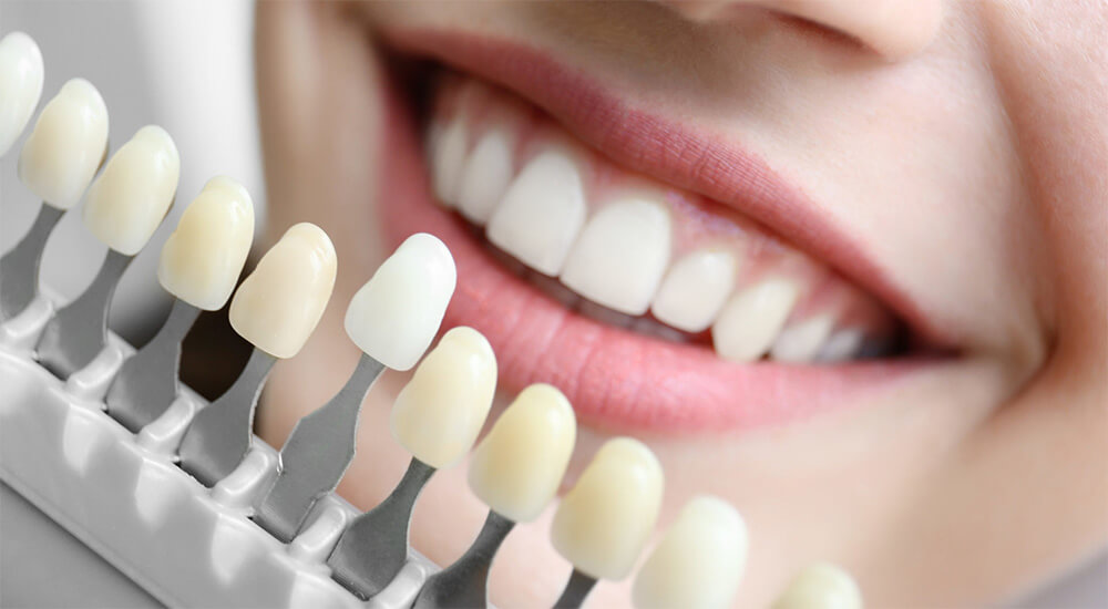 Laminate Veneers antalya | Antalya Turkey  | Go Clinic Turkey