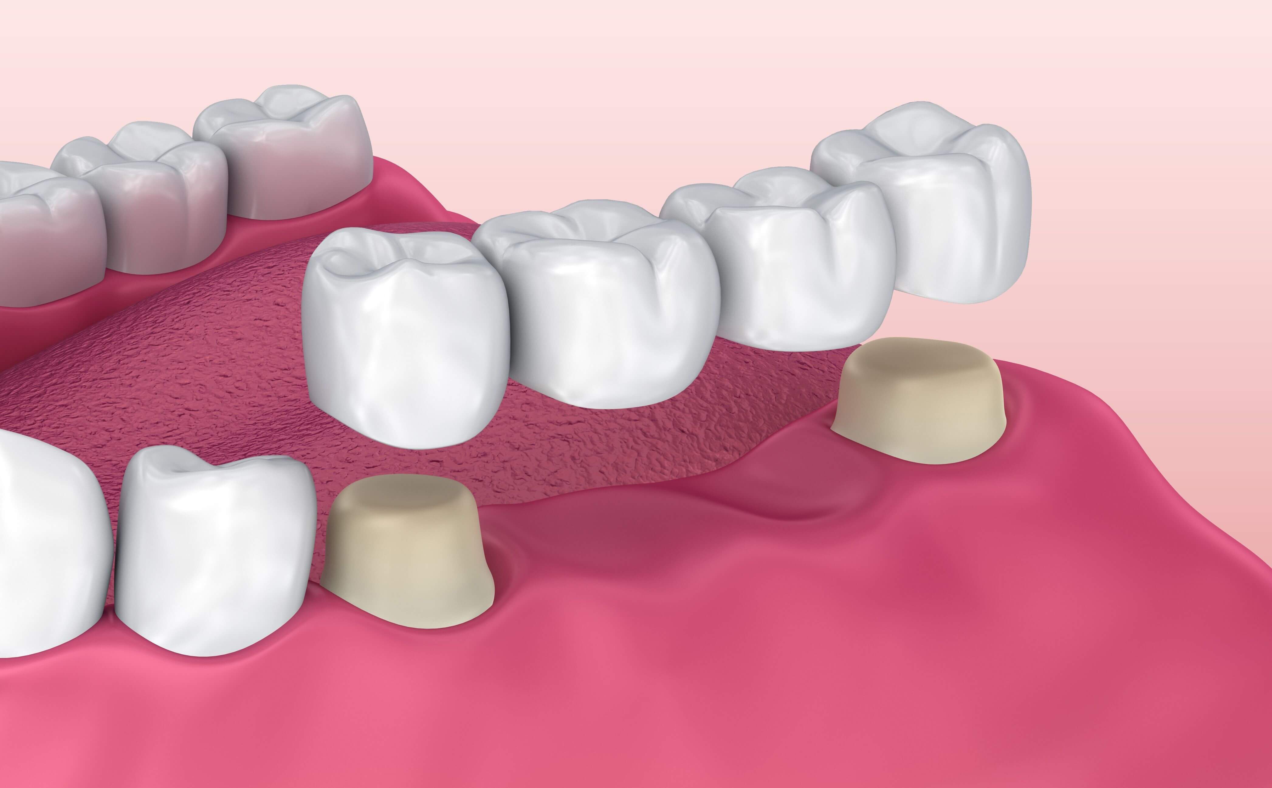 Dental Bridges | Antalya Turkey | Go Clinic Turkey