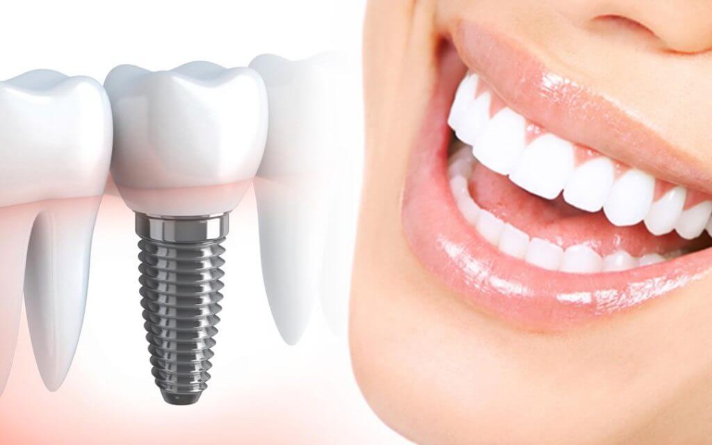 full mouth implant antalya | full mouth veneers antalya