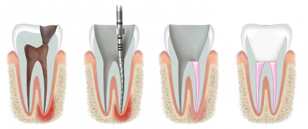 Root Canal Treatment (Endodontic Treatment) | Antalya Turkey | Go Clinic Turkey